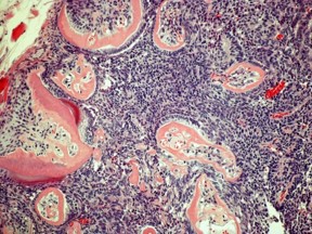 Describen el papel de la proteína IKKβ en la formación de tumores odontogénicos