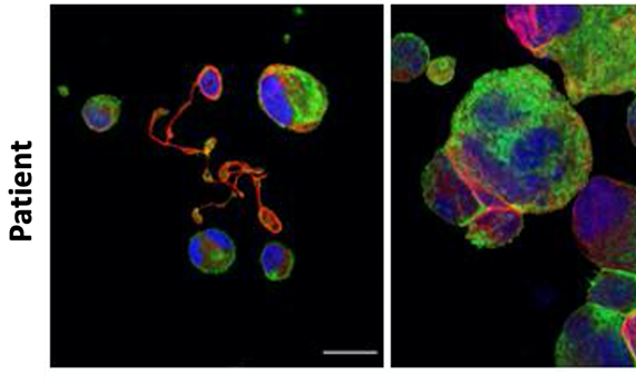 Los pacientes con la trombocitopenia congénita TUBB1-RT muestran una gran heterogeneidad clínica