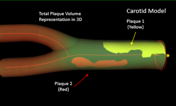 La ecografía vascular en 3D matrix identifica con precisión el daño cardiovascular en personas sanas