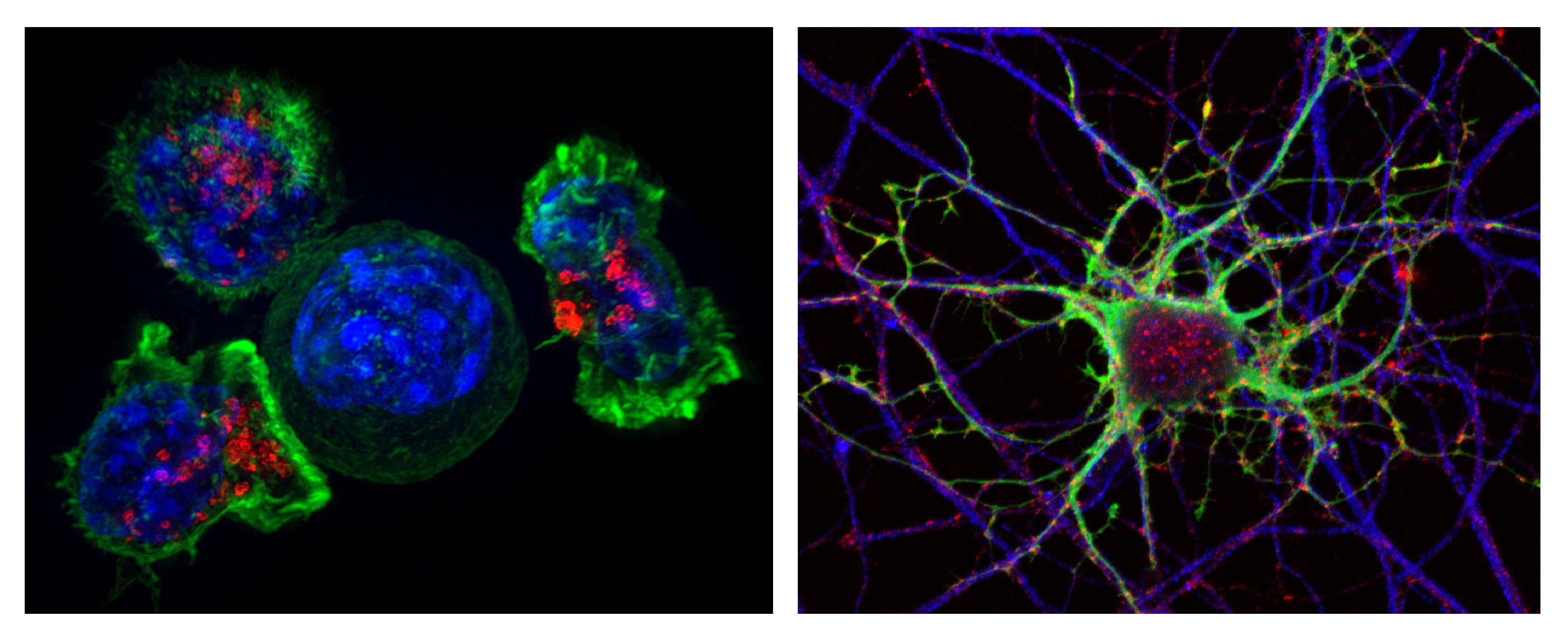 Analizan datos de vida real para mejorar la investigación de la relación entre cáncer y neurodegeneración