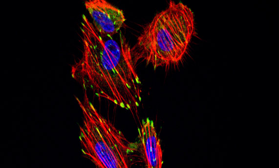 Inhibición de la dimerización de ERK para el tratamiento del carcinoma anaplásico de tiroides Inhibición de la dimerización de ERK para el tratamiento del carcinoma anaplásico de tiroides