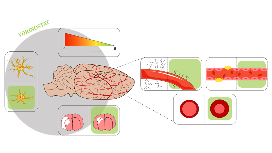 Un fármaco para un tipo de cáncer podría mejorar los síntomas después de un ictus cerebral