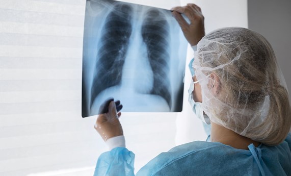 La IA ayuda a predecir la respuesta a inmunoterapia en cáncer de pulmón con datos reales de historia clínica y hemograma La IA ayuda a predecir la respuesta a inmunoterapia en cáncer de pulmón con datos reales de historia clínica y hemograma