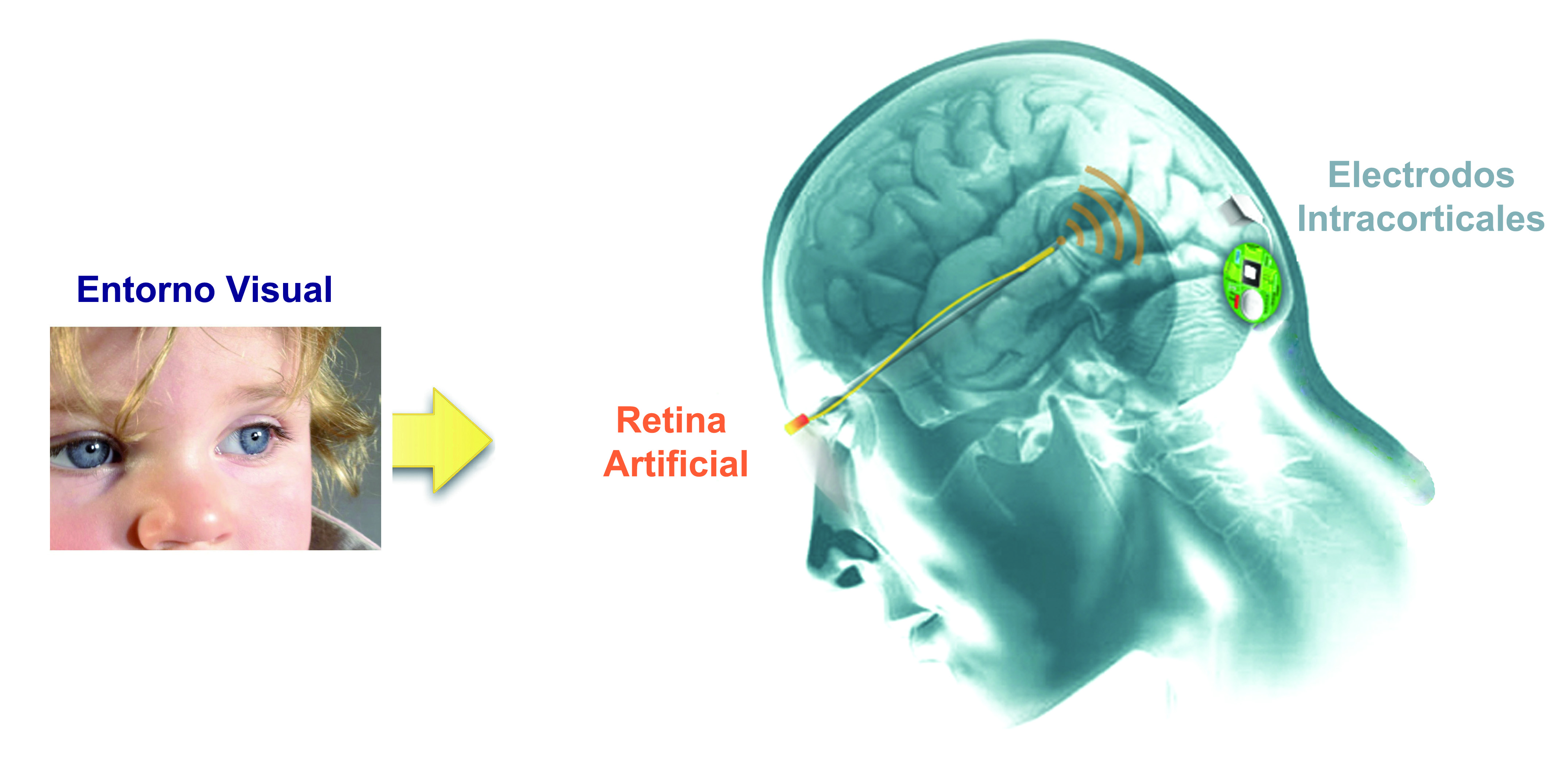 Logran una recuperación inesperada de la visión en una persona ciega mediante microestimulación cerebral