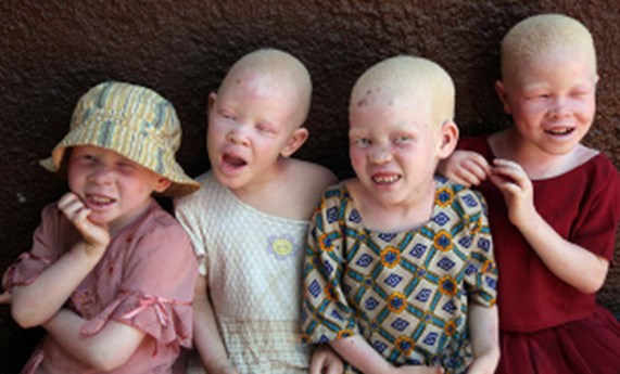Albinism in Africa organiza un congreso internacional sobre albinismo en Camerún