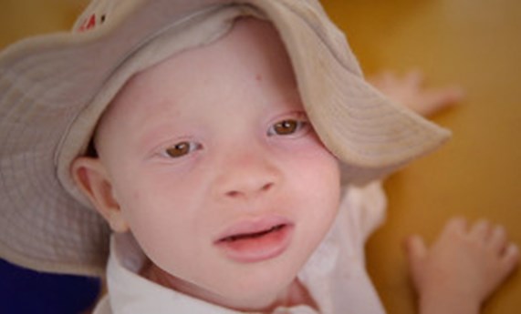 El documental "Hombre negro, piel blanca" da a conocer la cruel realidad de los albinos en África