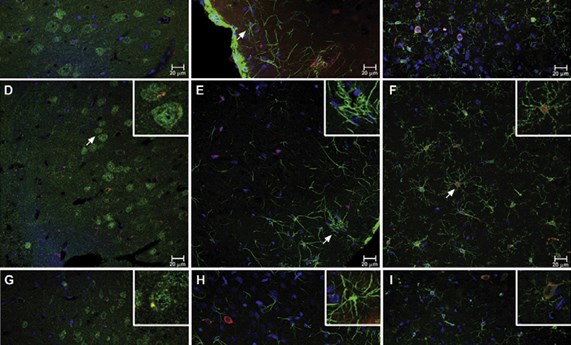 Posible papel de la translocación bacteriana intestinal en la fisiopatología de la depresión Posible papel de la translocación bacteriana intestinal en la fisiopatología de la depresión