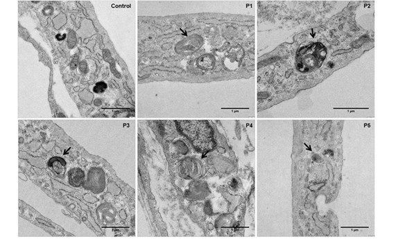 Describen un aumento del estrés oxidativo en individuos con enfermedad metabólica Describen un aumento del estrés oxidativo en individuos con enfermedad metabólica