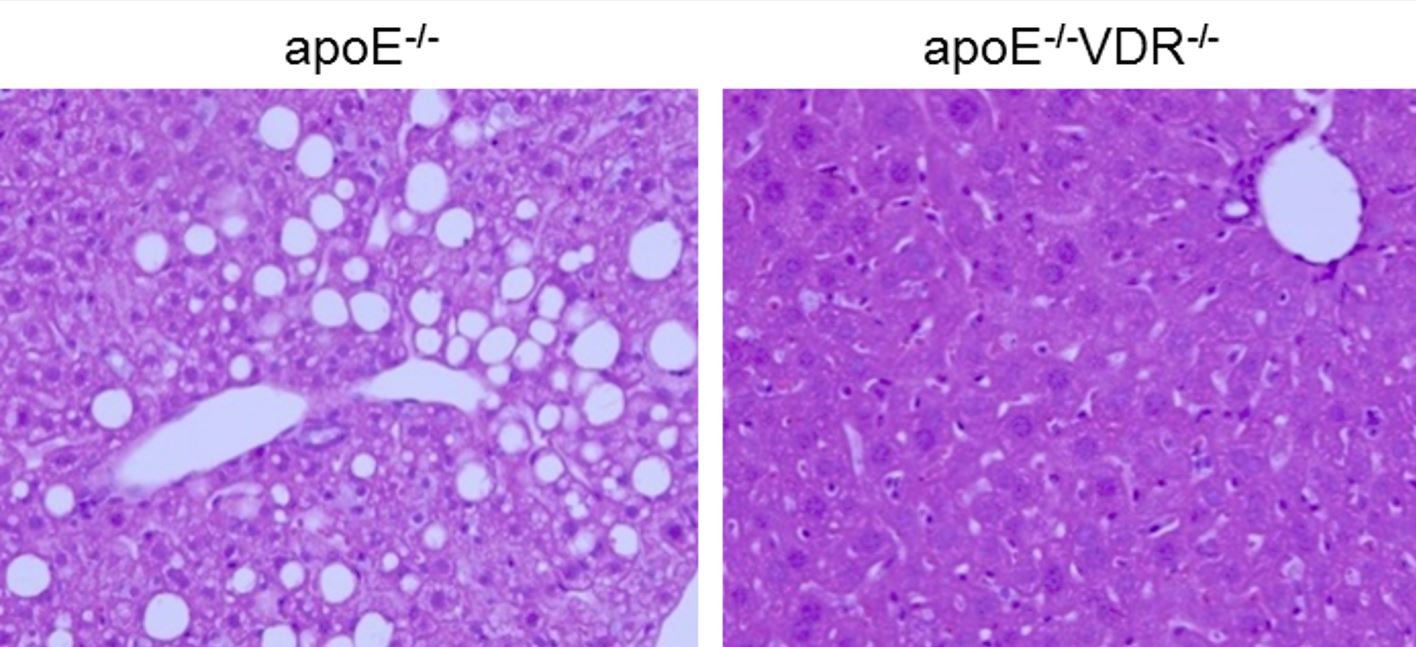 La concentración del receptor de vitamina D aumenta en una etapa temprana de la enfermedad del hígado graso no alcohólico y promueve la esteatosis