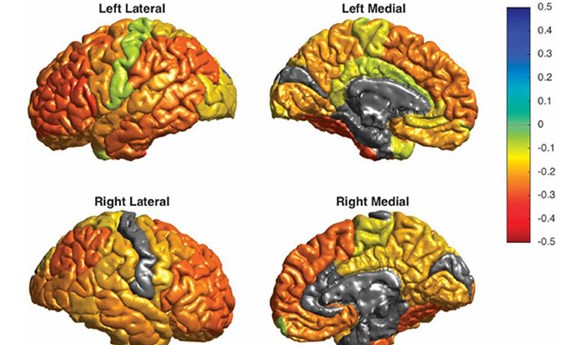 Elaborado el primer mapa global de las alteraciones cerebrales en pacientes con trastorno bipolar Elaborado el primer mapa global de las alteraciones cerebrales en pacientes con trastorno bipolar