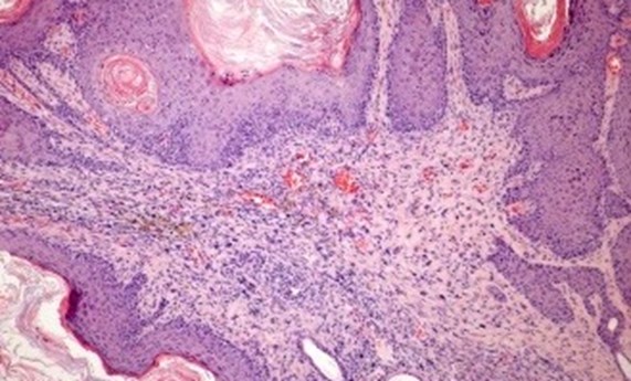 Demuestran el papel que ejerce la proteína IKKbeta en el cáncer de piel Demuestran el papel que ejerce la proteína IKKbeta en el cáncer de piel