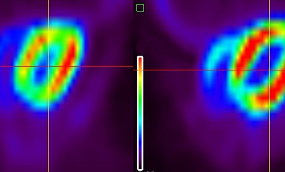 Relacionan el uso de nuevos fármacos contra el cáncer con problemas cardiovasculares Relacionan el uso de nuevos fármacos contra el cáncer con problemas cardiovasculares